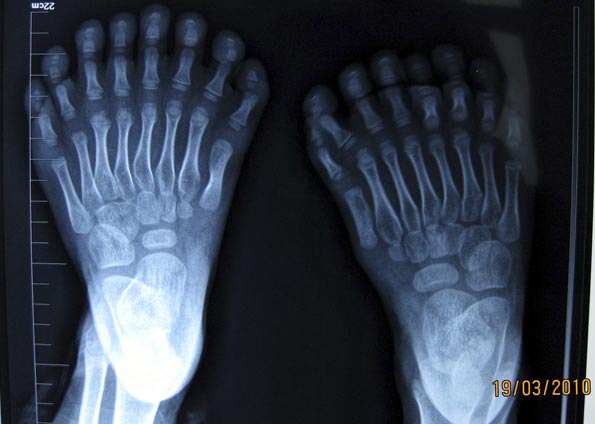 Imagem de raio X tirado no dia 19 mostra os pés de garoto de 6 anos que nasceu com 15 dedos na mão e 16 dedos nos pés na China. (Foto: Reuters) 