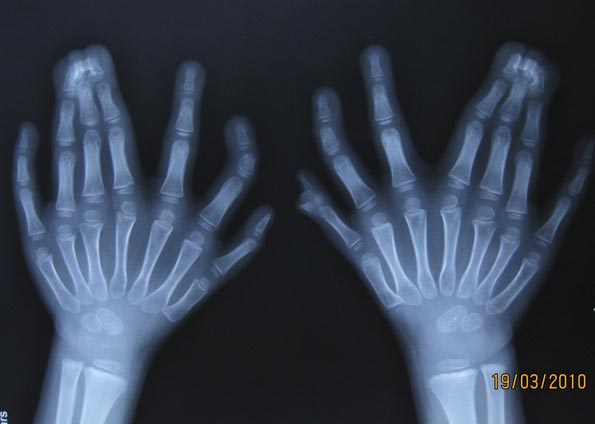 Radiografia feita no mesmo dia mostra as mãos da criança. Os médicos contabilizam a pequena protuberância que se vê na mão à direita na foto. Observe que o primeiro dedo tem 'duas pontas' em formação. (Foto: Reuters) 